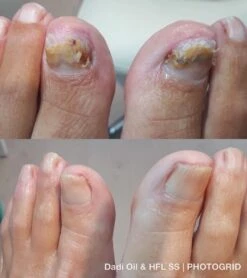 De Nummer 1 Tegen Schimmelnagels! - HFL - Laboratories - Solution Spray - 50ml + Dadi'Oil Nagelriem Olie - 3.75ml - Kalknagel Spray - Schimmelnagel Spray - Nagelriem Olie - Nagelverzorging -Gillette Winkel 1065x1200 1