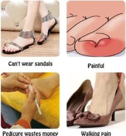 Merkloos Ingegroeide Teennagel Corrector -Gillette Winkel 1111x1200 9