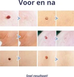 Steelwratjes Verwijderaar - Steelwratjes Verwijderen - Pijnloos En Snel - Wrattenverwijderaar - Steelwratten -Gillette Winkel 1148x1200 3