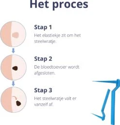 Steelwratjes Verwijderaar - Steelwratjes Verwijderen - Pijnloos En Snel - Wrattenverwijderaar - Steelwratten -Gillette Winkel 1154x1200 9
