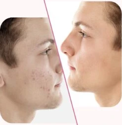 Merkloos Pimple Patch - Acne Patch - Puisten Patch - Acne Sticker - Puisten Pleister - Pimple Patches - Acne Pleister - Puisten Verwijderaar - Puisten Creme - Acne Verwijderen Set - Acneverzorging | 36 Stuks & Directe Levering -Gillette Winkel 1176x1200 15