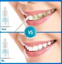 B-care Tanden Bleker – Wittere Tanden – Teeth Whitening Strips – Professioneel Resultaat - Tandsteen Verwijderaar - Zonder Peroxide - Tandenbleekset - Tanden Bleken 17 B-care Tanden Bleker – Wittere Tanden – Teeth Whitening Strips – Professioneel Resultaat - Tandsteen Verwijderaar - Zonder Peroxide - Tandenbleekset - Tanden Bleken -Gillette Winkel 1177x1200