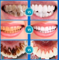 B-care Tanden Bleker – Wittere Tanden – Teeth Whitening Strips – Professioneel Resultaat - Tandsteen Verwijderaar - Zonder Peroxide - Tandenbleekset - Tanden Bleken 23 B-care Tanden Bleker – Wittere Tanden – Teeth Whitening Strips – Professioneel Resultaat - Tandsteen Verwijderaar - Zonder Peroxide - Tandenbleekset - Tanden Bleken -Gillette Winkel 1181x1200 1
