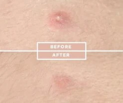 COSRX Acne Pimple Master 34 COSRX Acne Pimple Master -Gillette Winkel 1200x1008 2