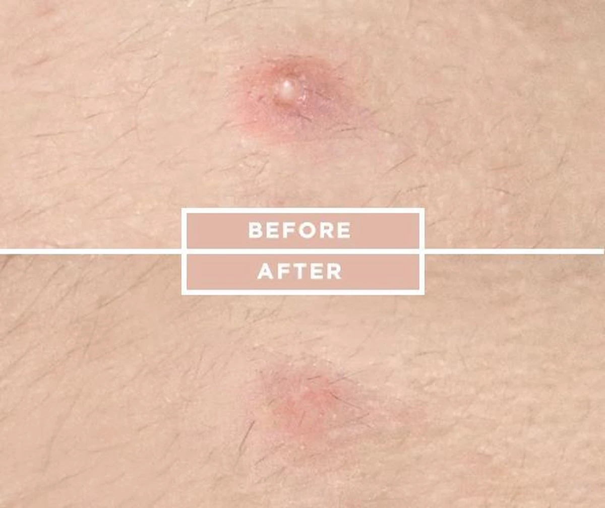 COSRX Acne Pimple Master 17 COSRX Acne Pimple Master - Afbeelding 15