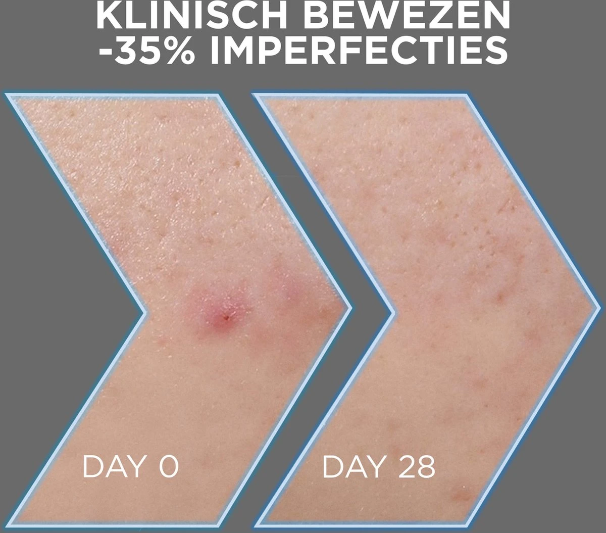 Garnier PureActive AHA + BHA Charcoal Anti-Onzuiverheden Serum - 30ml 7 Garnier PureActive AHA + BHA Charcoal Anti-Onzuiverheden Serum - 30ml - Afbeelding 5