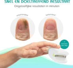 Anti Schimmelnagel Zelf-laserapparaat Incl. Pedicure Set 15 Anti Schimmelnagel Zelf-laserapparaat Incl. Pedicure Set -Gillette Winkel 1200x1120 9