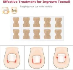 Merkloos Ingegroeide Teennagel Corrector -Gillette Winkel 1200x1146 9