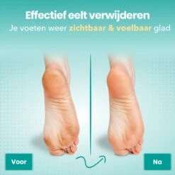 FreshDragon Elektrische Eelt Verwijderaar - Voetvijl - Inclusief 3 Rollers - Oplaadbaar -Gillette Winkel 1200x1200 1829