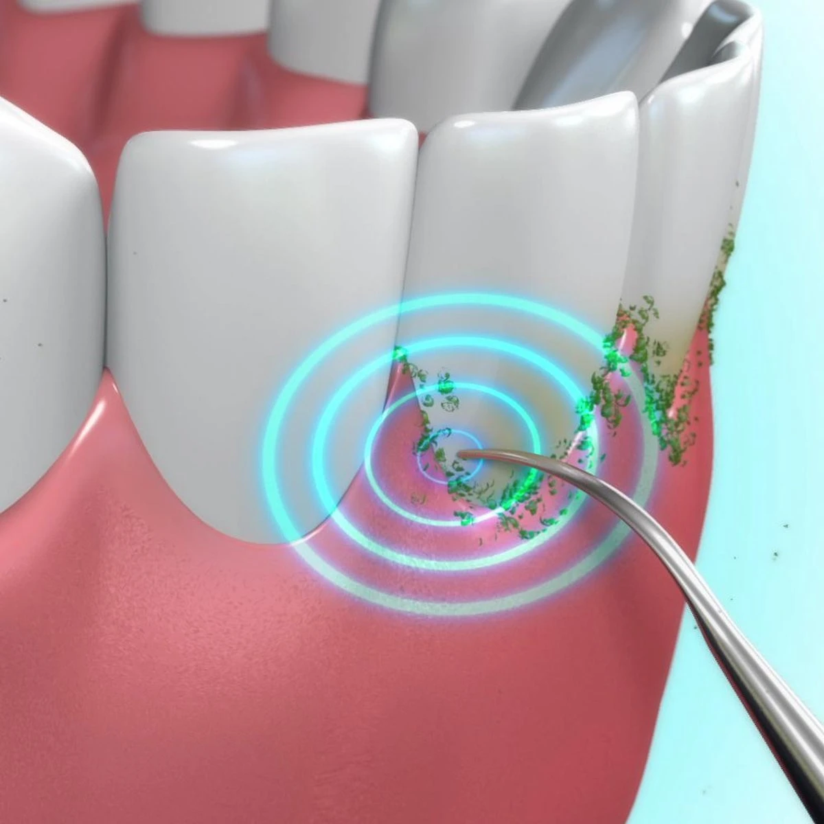 Toppers Van TV - Sonic Tandsteenverwijderaar - Tandplakverwijderaar 8 Toppers Van TV - Sonic Tandsteenverwijderaar - Tandplakverwijderaar - Afbeelding 6