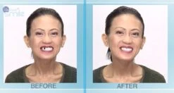 Tand Afgebroken Reparatie Kit InstantSmile Gebit (goedkope Kunstgebit) - Multi Shade 12 Tand Afgebroken Reparatie Kit InstantSmile Gebit (goedkope Kunstgebit) - Multi Shade -Gillette Winkel 1200x639