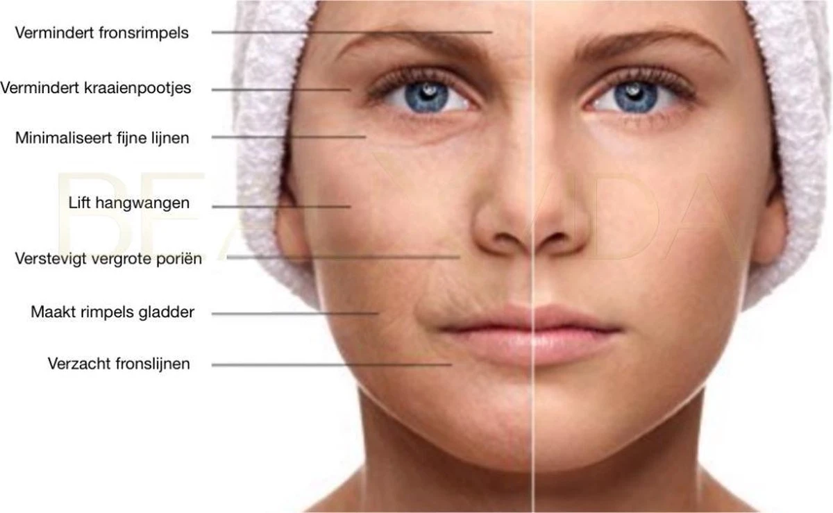 Titanium - 540 Micro-Needle 0.5mm DermaRoller | Skin Roller | Gezichts- En Huidverzorging | Huidverjonging | Steriel Verpakt | Gold Edition 4 Titanium - 540 Micro-Needle 0.5mm DermaRoller | Skin Roller | Gezichts- En Huidverzorging | Huidverjonging | Steriel Verpakt | Gold Edition - Afbeelding 2