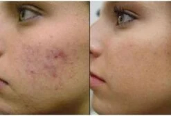 Merkloos Dermaroller 0.3mm Needle - Micro Needling Roller - Anti Acne/Cellulitis/Rimpels/Littekens/Striae Lichaams & Gezichts Roller -Gillette Winkel 1200x809 1