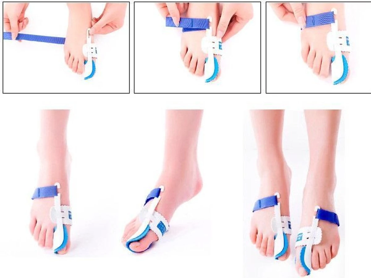 Hallux Valgus Statische Nachtspalk - Rechts + Links - Foot Pijnbestrijding - Teen Separator - Duim Corrector - Blauw / Wit 6 Hallux Valgus Statische Nachtspalk - Rechts + Links - Foot Pijnbestrijding - Teen Separator - Duim Corrector - Blauw / Wit - Afbeelding 4