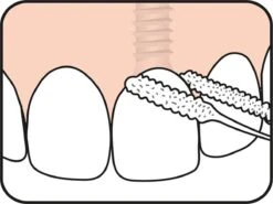 Tepe Floss Bridge & Implant 30 St -Gillette Winkel 1200x899 5