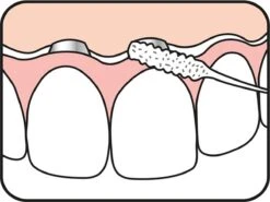 Tepe Floss Bridge & Implant 30 St -Gillette Winkel 1200x901