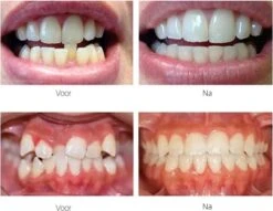 Edoir Rechte Tanden Beugel - Retainer Voor Rechte Tanden - Rechte Tanden Bitje 13 Edoir Rechte Tanden Beugel - Retainer Voor Rechte Tanden - Rechte Tanden Bitje -Gillette Winkel 1200x929