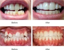 SAMA Direct™ Rechte Tanden Zonder Beugel - Orthodontische Bitjes - Rechte Tanden Bitje - Beugel - Knarsbitje - Nachtbeugel - Knarsen Bitje - Rechte Tanden - Witte Tanden 10 SAMA Direct™ Rechte Tanden Zonder Beugel - Orthodontische Bitjes - Rechte Tanden Bitje - Beugel - Knarsbitje - Nachtbeugel - Knarsen Bitje - Rechte Tanden - Witte Tanden -Gillette Winkel 1200x938