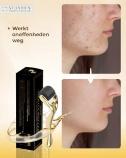 Dermaroller – 540 Micro Naalden – 0.5 MM Needle – Huidverjonging – Huidverzorging – Littekens – Striea – Steriel Verpakt -Gillette Winkel 960x1200 41